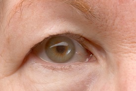 Ptosis treatment in Euless, TX