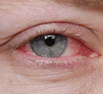 Pink Eye Treatment in Colleyville, TX